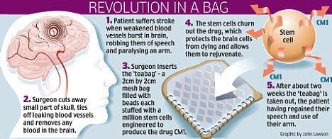 The miracle teabag: Stem cells in a pack help stroke victim to talk ...