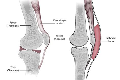 Prepatellar (Kneecap) Bursitis – Modern Orthopaedics of New Jersey