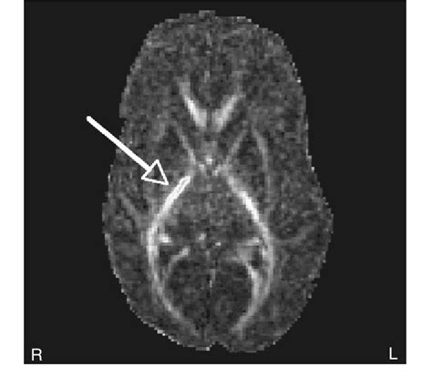 Magnetic resonance diffusion tensor imaging fractional anisotropy (FA)... | Download Scientific ...