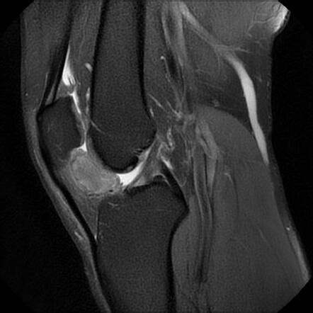 Intracapsular chondroma - knee | Image | Radiopaedia.org