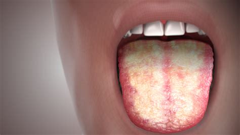 Candidiasis FI - Scientific Animations