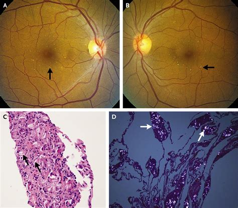 Talc Retinopathy | NEJM