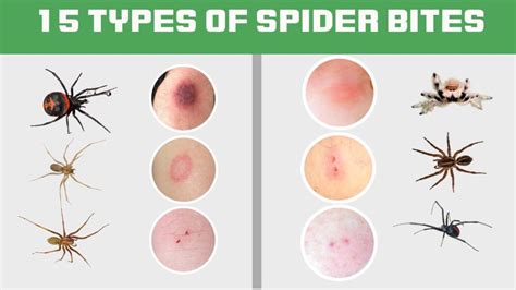 15 Types Of Spider Bites: Identification Chart with Picture