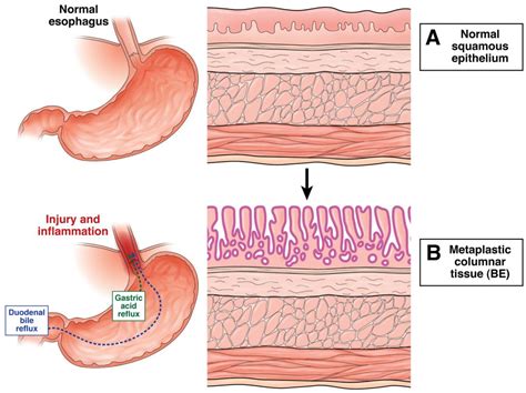 Barretts Esophagus Explained And Shown Using Medical Animation Still Shot | Images and Photos finder