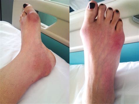 Multiple Septic Bursitis and Spontaneous Achilles Tendon Tear in Systemic Lupus Erythematosus ...