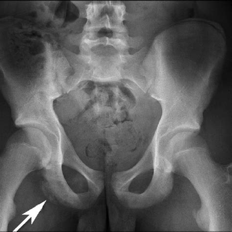 (PDF) A novel approach to treatment for chronic avulsion fracture of the ischial tuberosity in ...