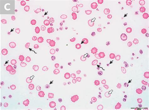 Blood Smear Platelet Evaluation & Interpretation | Clinician's Brief