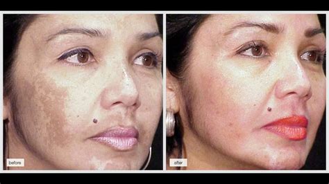 4% Hydroquinone Cream for Discoloration, Melasma, Skin Lightening and ...