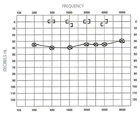 Audiograms | Aussie Deaf Kids