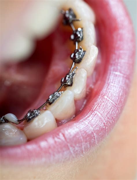 Lingual Braces vs. Traditional Braces