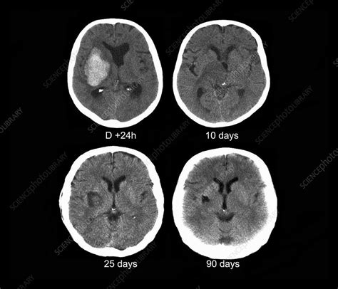 Stroke, CT scans - Stock Image - C015/4945 - Science Photo Library