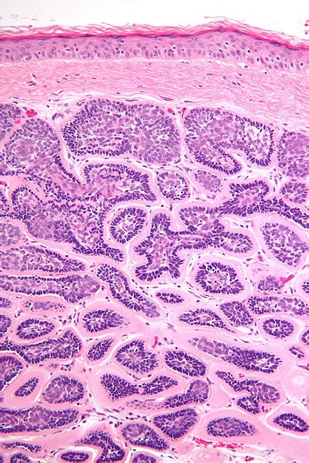 Dermal cylindroma - Libre Pathology