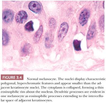 Melanocytic Lesions | Basicmedical Key