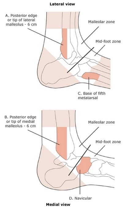 Ankle sprain - WikEM