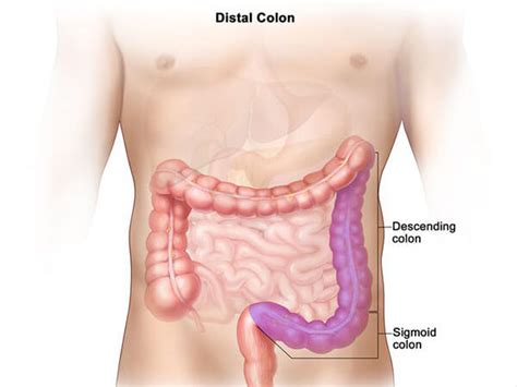 Colorectal Cancer Survival Linked to Tumor Location - NCI