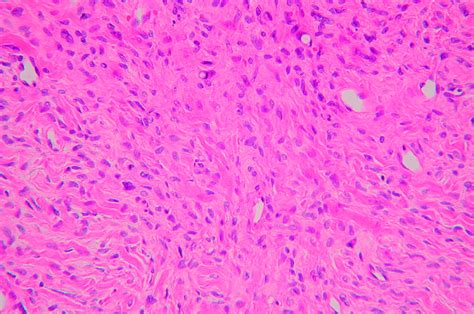 Mpnst Histology