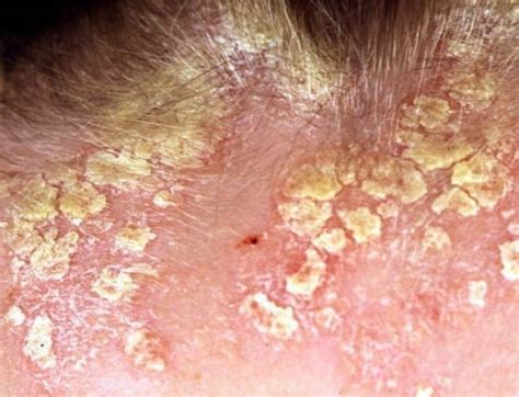 seborrheic dermatitis images | Symptoms and pictures