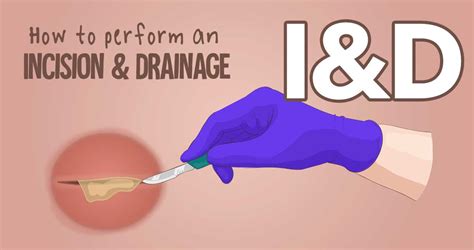 I&D: How to perform an Incision & Drainage | Health And Willness