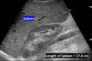 Spleen Ultrasound – How to Measure Length of the Spleen and Assess for Splenomegaly with ...