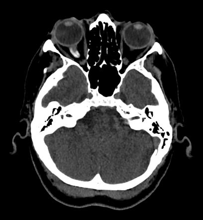 Optic nerve meningioma | Radiology Case | Radiopaedia.org