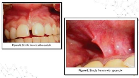 FRENAL ATTACHMENT & ITS MANAGEMENT | PPT