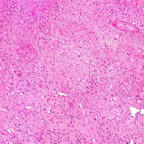 Epithelioid Hemangioendothelioma | Basicmedical Key