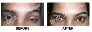 Ptosis Surgery Cost Kochi | Droopy Eyelid Surgery Kerala