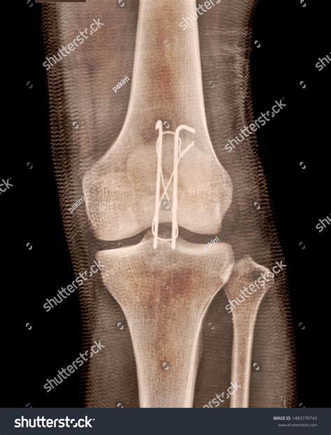 X Ray Fracture Knee Replacement Stock Photo 1483779743 | Shutterstock