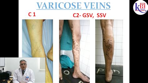 Varicose Veins : Treatment without Surgery in just one sitting