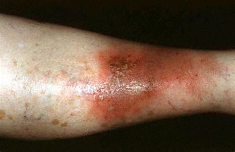 Cellulitis - Pictures, Symptoms, Treatment, Contagious, Causes, Types | hubpages