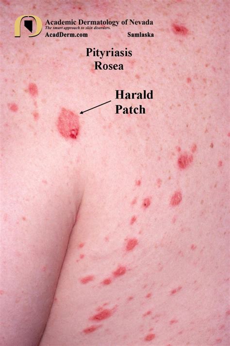 Pityriasis Rosea-It starts with a Herald Patch... - Academic ...