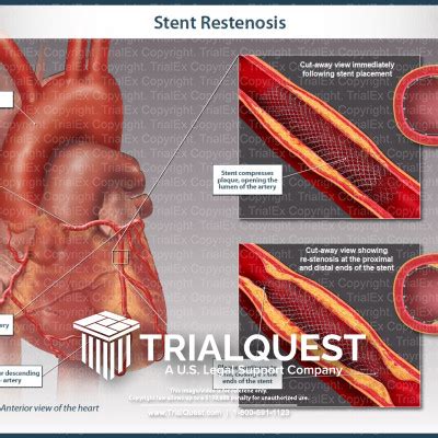 Medical Legal Exhibits - Legal Animations & Trial Graphics - Tria...