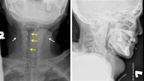 Anaplastic thyroid carcinoma – Radiology Cases