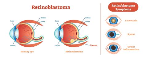 Potential treatment for eye cancer using tumor-killing…