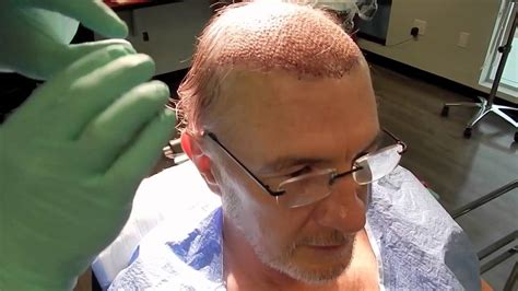 Best Hair Transplant Surgery by Hair Restoration Surgeon - YouTube