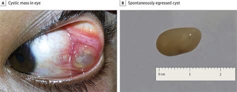 Cysticercosis causes, prevention, symptoms, diagnosis and treatment