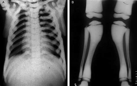 Infantile osteopetrosis associated with osteomyelitis | BMJ Case Reports