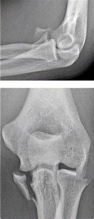 Coronoid Fractures - Trauma - Orthobullets