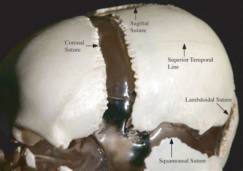 Parietal Bone