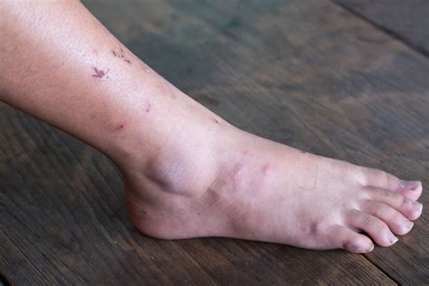 News - UK-wide clinical trial to test new treatment for diabetic foot ...