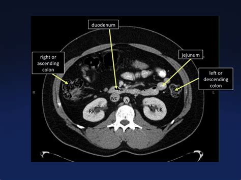 Ct Cross Sectional Anatomy - Anatomical Charts & Posters