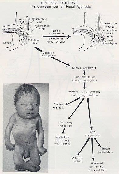 Doctors Gates: MNEMONIC for Features of Potter syndrome Obstetric ...