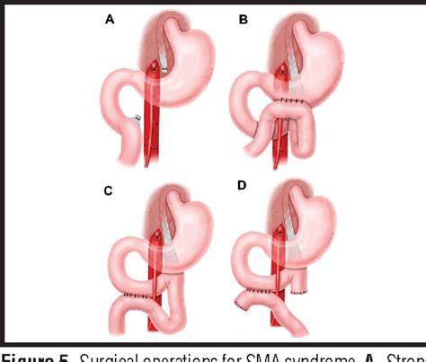 Figure 5 from Superior Mesenteric Artery Syndrome | Semantic Scholar