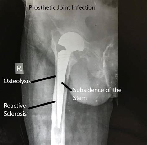 Joint Replacement Infection | Causes & Symptoms | Complete Orthopedics