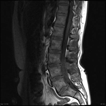 Epidural abscess and facet joint septic arthritis | Radiology Case | Radiopaedia.org