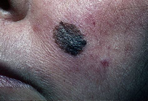 Melanoma on Face Pictures – 22 Photos & Images / illnessee.com