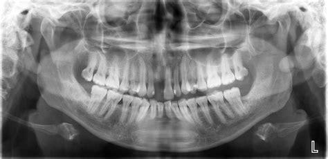 Mandibular Fracture X Ray