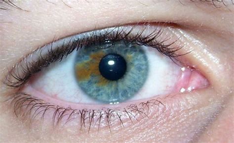 Causes - Heterochromia