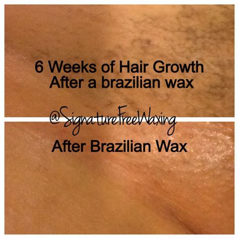 Top photo: 6 weeks after receiving a Brazilian wax at Signature Free ...