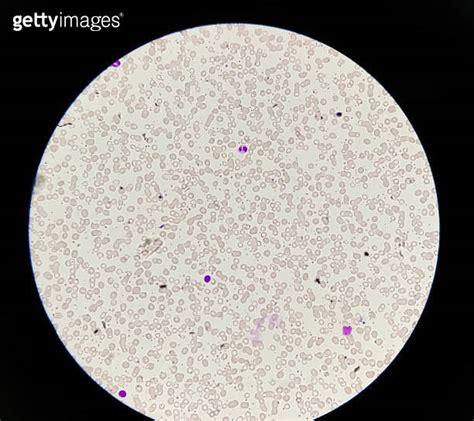 Hematology blood smear leishman stain under light microscope show microcytic hyprocromic anemia ...